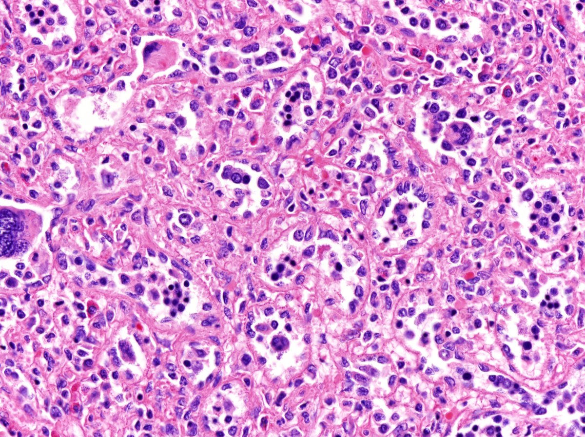 High power view. Note the increased granulocytic proliferation both intrasinusoidally and within the splenic cords. Megakaryocytes are also noted